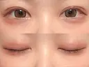 二重埋没 アリエル美容クリニック 大宮院 DAY 9 サムネイル用