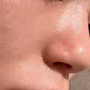 エレクトロポレーション / 毛穴洗浄（ハイドラフェイシャルなど） Fellez Clinic【フェルズクリニック】 AFTER サムネイル用