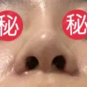 小鼻縮小（切開） 恵聖会クリニック 京橋院 DAY 12 サムネイル用