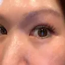 下まぶたの脂肪取り 芦屋美容クリニック 芦屋院 DAY 11 サムネイル用