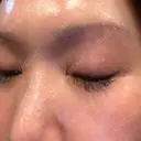 下まぶたの脂肪取り 芦屋美容クリニック 芦屋院 DAY 11 サムネイル用