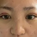 二重埋没 / その他（鼻） / 上まぶたの脂肪取り / ボトックス（エラ・小顔） TCB東京中央美容外科 岡山院 AFTER サムネイル用