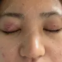 二重埋没 / その他（鼻） / 上まぶたの脂肪取り / ボトックス（エラ・小顔） TCB東京中央美容外科 岡山院 DAY 1 サムネイル用