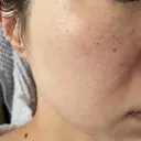 光治療（フォトフェイシャルなど） 渋谷美容外科クリニック 新橋院 DAY 3 サムネイル用