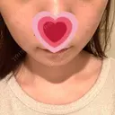 イオン導入 / フォトRF 湘南美容クリニック 表参道院 AFTER サムネイル用