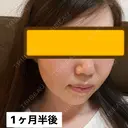 糸リフト / ヒアルロン酸注入（頬） EMMA CLINIC（エマクリニック） DAY 45 サムネイル用