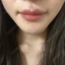 骨切り（あご） 銀座マイアミ美容外科 DAY 31 サムネイル用