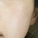 白玉点滴・注射 TCB東京中央美容外科 福岡博多院 AFTER サムネイル用