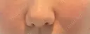 鼻翼基部形成（貴族手術） ノーチェビューティクリニック DAY 0 サムネイル用