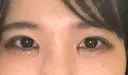 目頭切開 eクリニック 金沢本院 DAY 11 サムネイル用