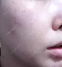 ピーリング（ニキビ・毛穴） / エレクトロポレーション / 光治療（フォトフェイシャルなど） AURORA CLINIC（オーロラクリニック）新宿院 DAY 2 サムネイル用