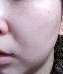 ピーリング（ニキビ・毛穴） / エレクトロポレーション / 光治療（フォトフェイシャルなど） AURORA CLINIC（オーロラクリニック）新宿院 DAY 2 サムネイル用