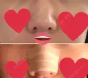 軟骨移植 フェアクリニック川口 DAY 5 サムネイル用