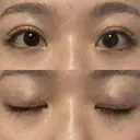 二重埋没 / シワ取りボトックス ルラ美容クリニック 渋谷本院 AFTER サムネイル用