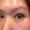 下まぶたの脂肪取り 芦屋美容クリニック 芦屋院 AFTER サムネイル用