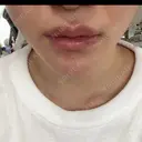 骨切り（あご） 銀座マイアミ美容外科 DAY 34 サムネイル用