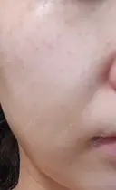 ピーリング（ニキビ・毛穴） / エレクトロポレーション / 光治療（フォトフェイシャルなど） AURORA CLINIC（オーロラクリニック）新宿院 DAY 4 サムネイル用