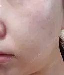 ピーリング（ニキビ・毛穴） / エレクトロポレーション / 光治療（フォトフェイシャルなど） AURORA CLINIC（オーロラクリニック）新宿院 AFTER サムネイル用