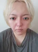 スレッドノーズ / 鼻尖形成（非切開） / その他（鼻） 品川美容外科 新宿院（※品川スキンクリニック提携） DAY 8 サムネイル用