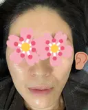額を丸く / こめかみ形成 / その他（肌） / 再生医療 / PRP皮膚再生療法 クリニックビューティー恵比寿 DAY 32 サムネイル用