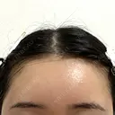 額を丸く / こめかみ形成 / 脂肪注入（額） あつぎ美容クリニック DAY 16 サムネイル用
