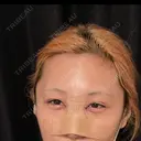 目頭切開 / 隆鼻術 / 鼻尖形成（切開） / 軟骨移植 湘南美容クリニック 金山院 DAY 0 サムネイル用