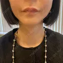 ヒアルロン酸注入（唇） 渋谷美容外科クリニック 新宿院 AFTER サムネイル用