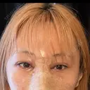 目頭切開 / 隆鼻術 / 鼻尖形成（切開） / 軟骨移植 湘南美容クリニック 金山院 DAY 1 サムネイル用