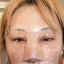 目頭切開 / 隆鼻術 / 鼻尖形成（切開） / 軟骨移植 湘南美容クリニック 金山院 DAY 2 サムネイル用