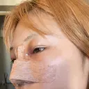 目頭切開 / 隆鼻術 / 鼻尖形成（切開） / 軟骨移植 湘南美容クリニック 金山院 DAY 2 サムネイル用