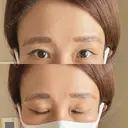 二重切開 / 眼瞼下垂（切開） 湘南美容クリニック Regno 銀座院 DAY 93 サムネイル用