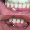 骨切り（あご） 銀座マイアミ美容外科 DAY 41 サムネイル用