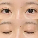 二重埋没 / 自然癒着法 シンデレラ＆ダヴィンチクリニック DAY 393 サムネイル用
