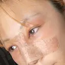 目頭切開 / 隆鼻術 / 鼻尖形成（切開） / 軟骨移植 湘南美容クリニック 金山院 DAY 3 サムネイル用