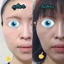 切開リフト LIKI CLINIC KOBE AFTER サムネイル用