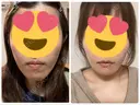 骨切り（あご） ヤスミクリニック DAY 95 サムネイル用