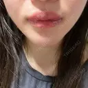 骨切り（あご） 銀座マイアミ美容外科 DAY 44 サムネイル用