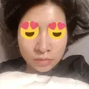 隆鼻術 / 鼻尖形成（切開） / 鼻中隔延長（切開） / 骨切幅寄せ 表参道スキンクリニック 表参道院 AFTER サムネイル用