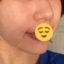 ピコレーザートーニング（美白・肝斑） / ピコフラクショナルレーザー（毛穴・ニキビ跡） いしかわ皮ふ科・形成外科 豊後大野院 DAY 3 サムネイル用