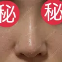 小鼻縮小（切開） 恵聖会クリニック 京橋院 AFTER サムネイル用