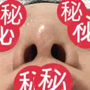 小鼻縮小（切開） 恵聖会クリニック 京橋院 DAY 33 サムネイル用