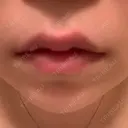 ヒアルロン酸注入（唇） 渋谷美容外科クリニック 池袋院 AFTER サムネイル用