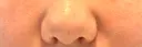 鼻翼基部形成（貴族手術） ノーチェビューティクリニック AFTER サムネイル用
