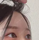 ヒアルロン酸注入（額） MSC LUNA CLINIC 渋谷院 DAY 4 サムネイル用