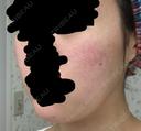 その他（肌） / 再生医療 / PRP皮膚再生療法 聖心美容クリニック 六本木院 DAY 7 サムネイル用
