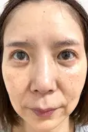 糸リフト / クマ治療 / 下まぶたたるみ取り / 下まぶたの脂肪取り / 眉下切開 / 脂肪注入（額） 銀座みゆき通り美容外科 東京本院 AFTER サムネイル用