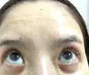 糸リフト / クマ治療 / 下まぶたたるみ取り / 下まぶたの脂肪取り / 眉下切開 / 脂肪注入（額） 銀座みゆき通り美容外科 東京本院 DAY 93 サムネイル用