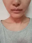 小鼻縮小（切開） / 人中短縮 / 口角挙上 / その他（口元） オザキクリニック LUXE新宿 DAY 30 サムネイル用