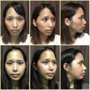 二重埋没 / 骨切り（あご） / 骨削り（頬） / 軟骨移植 / 骨切幅寄せ バノバギ整形外科 DAY 31 サムネイル用