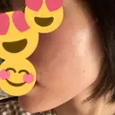 ピコレーザートーニング（美白・肝斑） / ピコフラクショナルレーザー（毛穴・ニキビ跡） いしかわ皮ふ科・形成外科 豊後大野院 AFTER サムネイル用